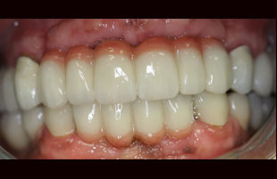 After — Full-mouth rehabilitation