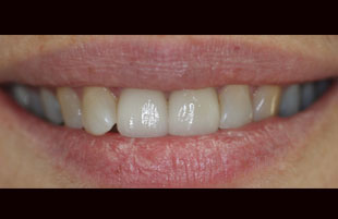 After — Whitening & cosmetic repair