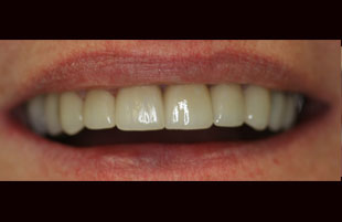 After — Anterior recontouring