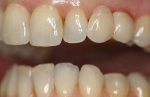After — All-porcelain crowns & veneers