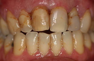 Before — Restoring a healthy smile