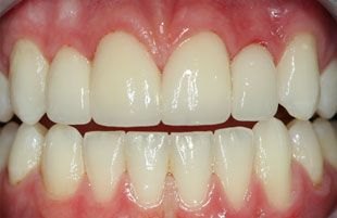 After — Full smile restoration with porcelain crowns