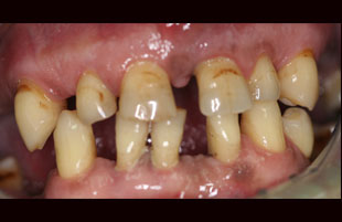 Before — Full-mouth rehabilitation
