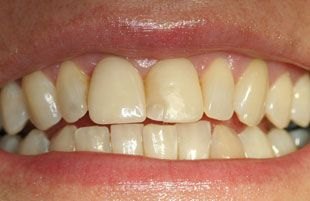 Before — Cosmetic smile makeover