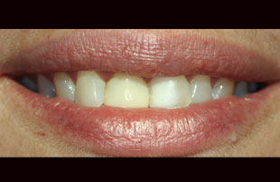 Before — Whitening & cosmetic repair