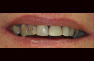 Before — Anterior recontouring