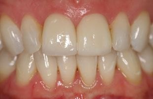 After — Cosmetic smile makeover