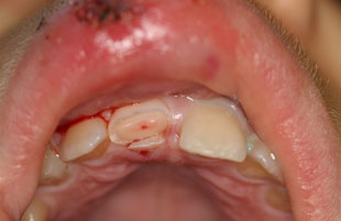 Before — Dental trauma reconstruction