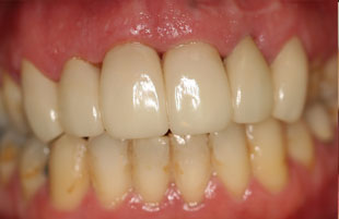 After — Restoring a healthy smile