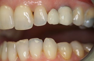 Before — All-porcelain crowns & veneers