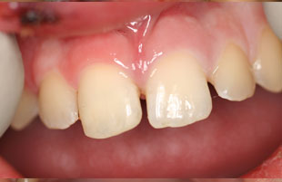 After — Dental trauma reconstruction