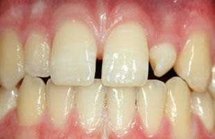 Before — Full smile restoration with porcelain crowns