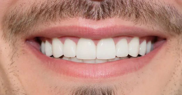 After full mouth restoration — restored healthy smile