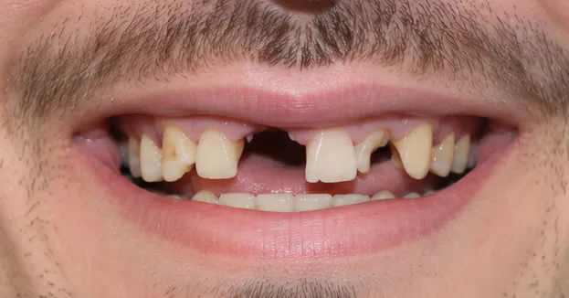 Full mouth restoration