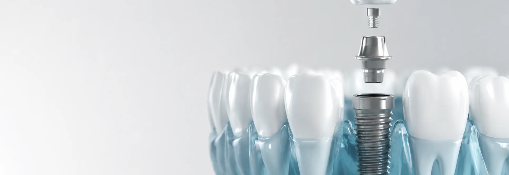 Computer guided dental implants at Goldberg Marcus Monteiro Dental Associates