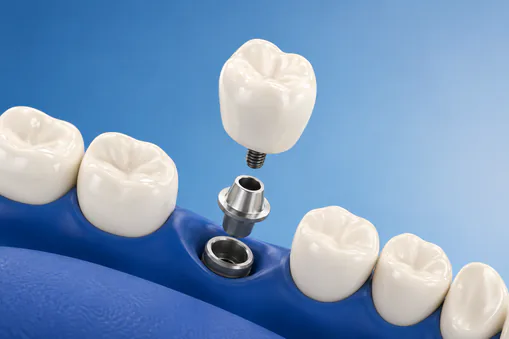 Experience Precision Implant Placement Like Never Before