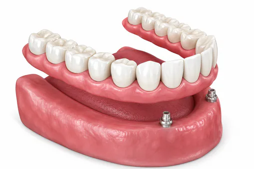 Overdenture