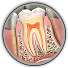 Root Canal Treatment Stratford